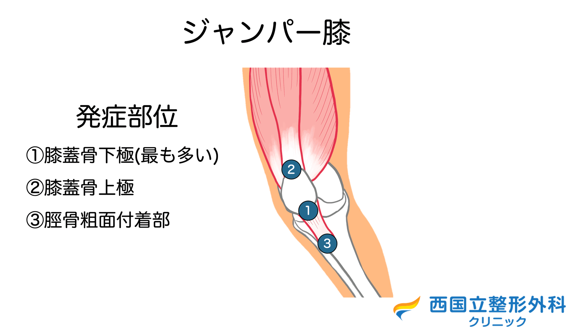 ジャンパー膝 発症部位
